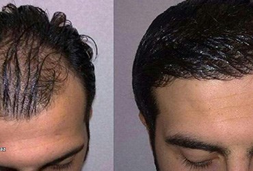 روش سیفر (SAFER)در کاشت مو چیست؟ 