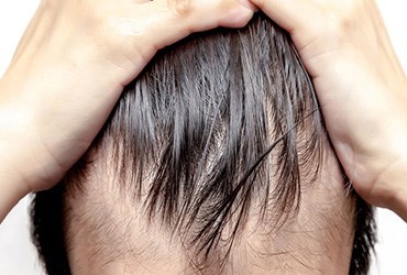 توضیحاتی در مورد روش کاشت موی اتوماتیک یا (SAFER)