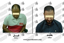 کاشت مو