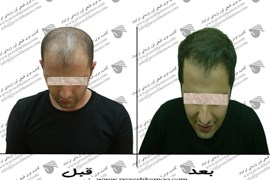 کاشت موی طبیعی