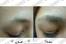 کاشت ابرو