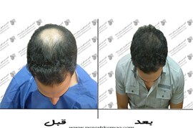 کاشت موی طبیعی