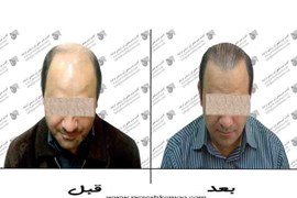 کاشت مو