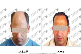 کاشت مو