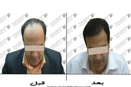 کاشت مو