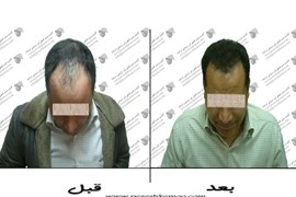 کاشت مو