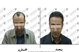 کاشت موی طبیعی
