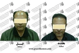 کاشت مو