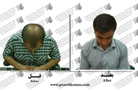 کاشت مو