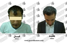 کاشت مو