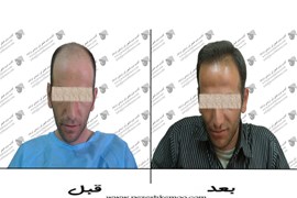 کاشت مو