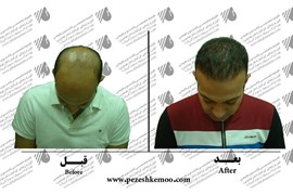 کاشت مو
