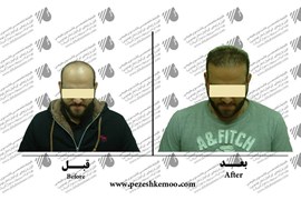 کاشت مو
