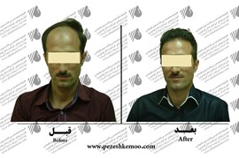 کاشت مو