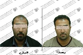 کاشت مو