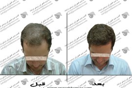 کاشت مو
