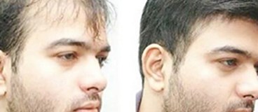 اخبار تازه در مورد روبات كاشت مو