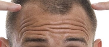 آخرین خبر ها درباره ی کشت مو (بازسازي سلول هاي مو)