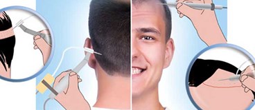What is SAFER method for hair transplantation?