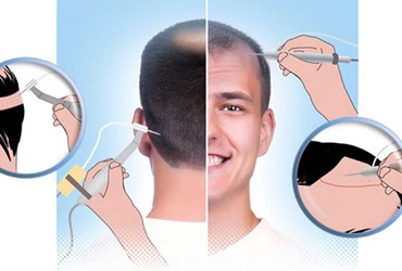 What is SAFER method for hair transplantation?