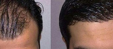 روش سیفر (SAFER)در کاشت مو چیست؟ 