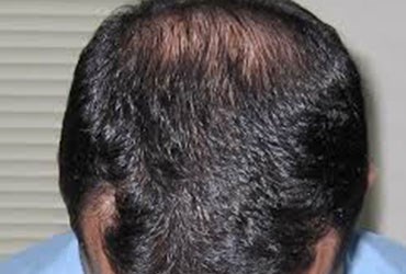 اعطای تاییدیه FDAبرای اولین بار به دستگاه لیزرتراپی هیرماکس