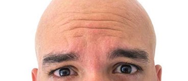 ابداع یک تست ژنتیکی برای احتمال وقوع طاسی