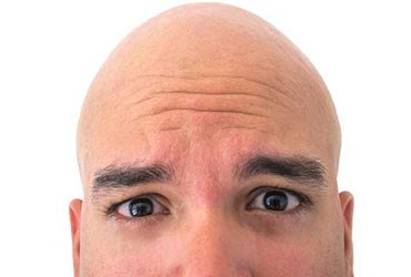 ابداع یک تست ژنتیکی برای احتمال وقوع طاسی