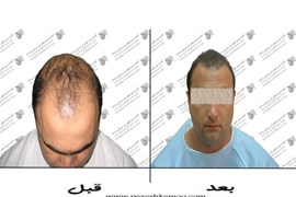 کاشت مو