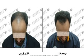 کاشت مو
