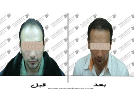 کاشت مو