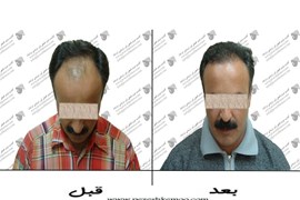کاشت مو