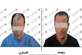 کاشت مو