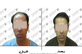 کاشت مو