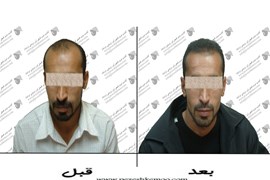 کاشت مو