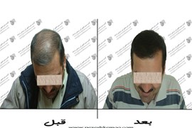 کاشت مو